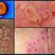 Illustration for article titled Obat penyakit herpes untuk kelamin priaem/em